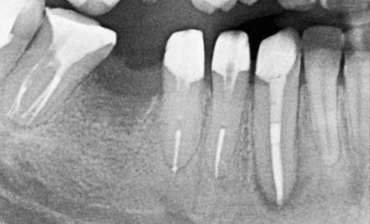 Caz 1 Endodonție - după