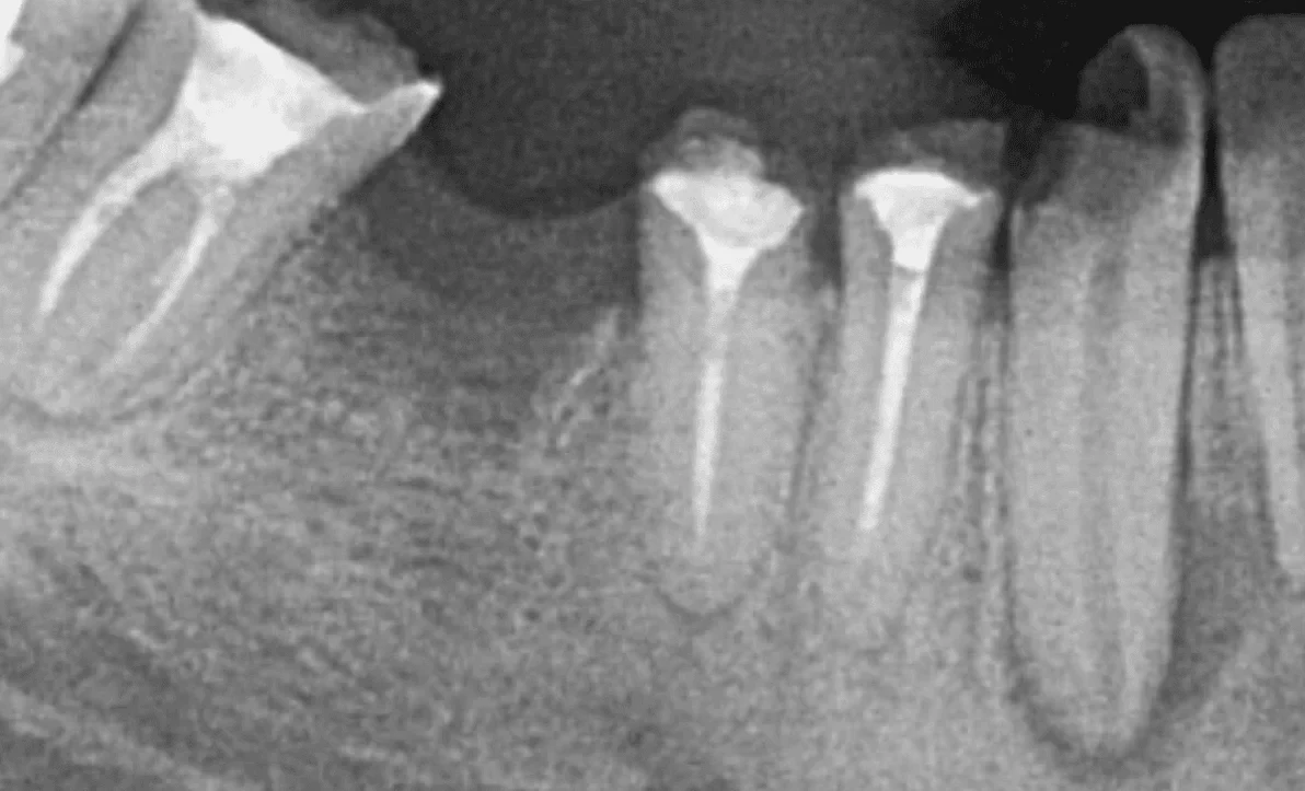Caz 1 Endodonție - înainte