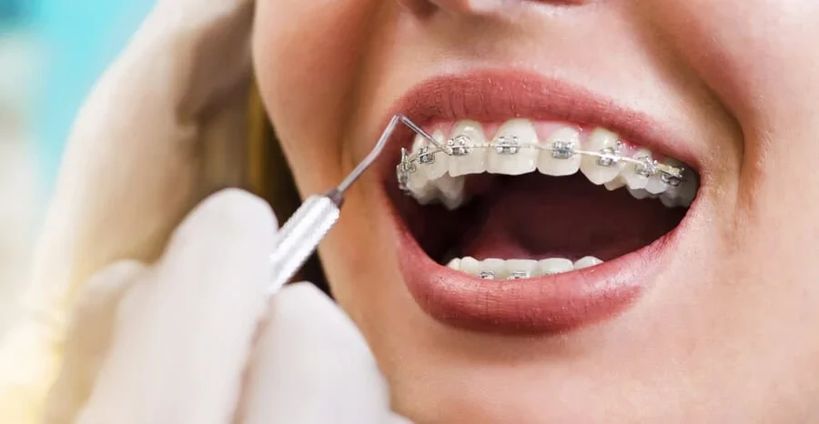 Tratament ortodontic — aparat dentar