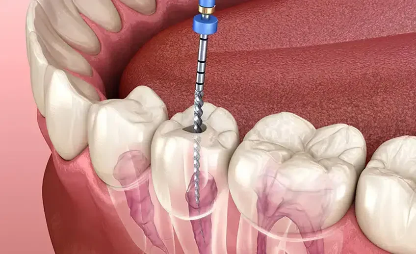 Cazuri Endodontie