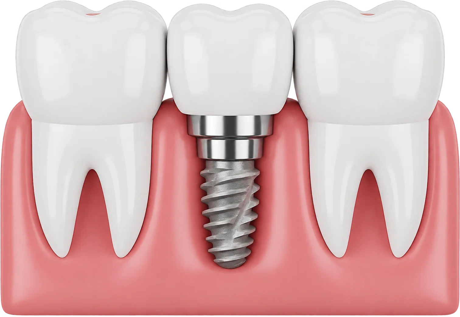 Imagine ilustrativă: coroană pe un implant conic cu filet larg, între doi dinți naturali