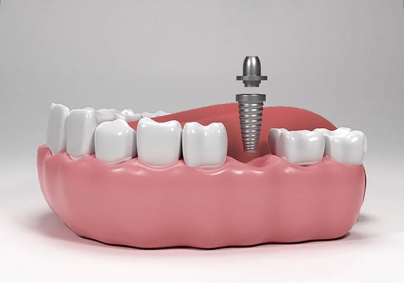 Model 3D: bontul protetic deasupra implantului