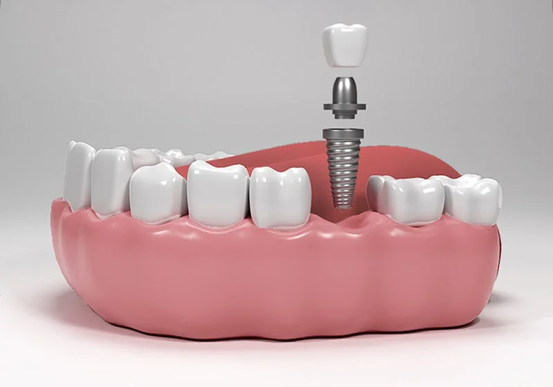 Model 3D: coroana dentară deasupra bontului și a implantului